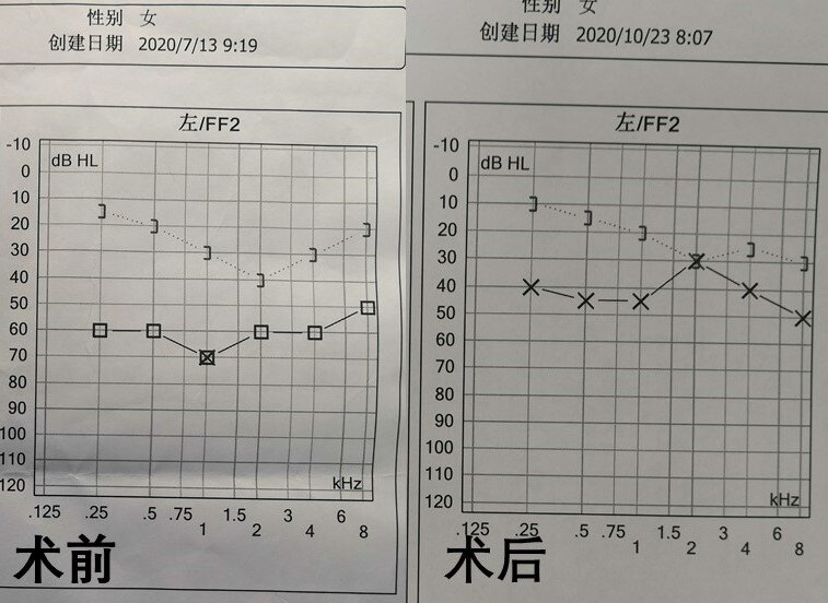 病例报道 特殊情况的鼓膜修补 钙化_鼓膜穿孔_鼓膜穿孔治疗方式 - 好
