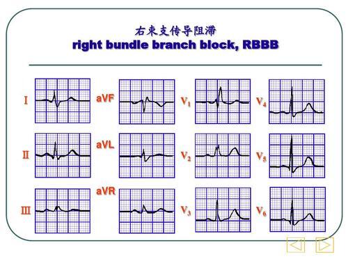 Mayo Clinic 右束支传导阻滞可能预示早期心肌病和不良预后 不可小觑 右束支传导阻滞 右束支传导阻滞