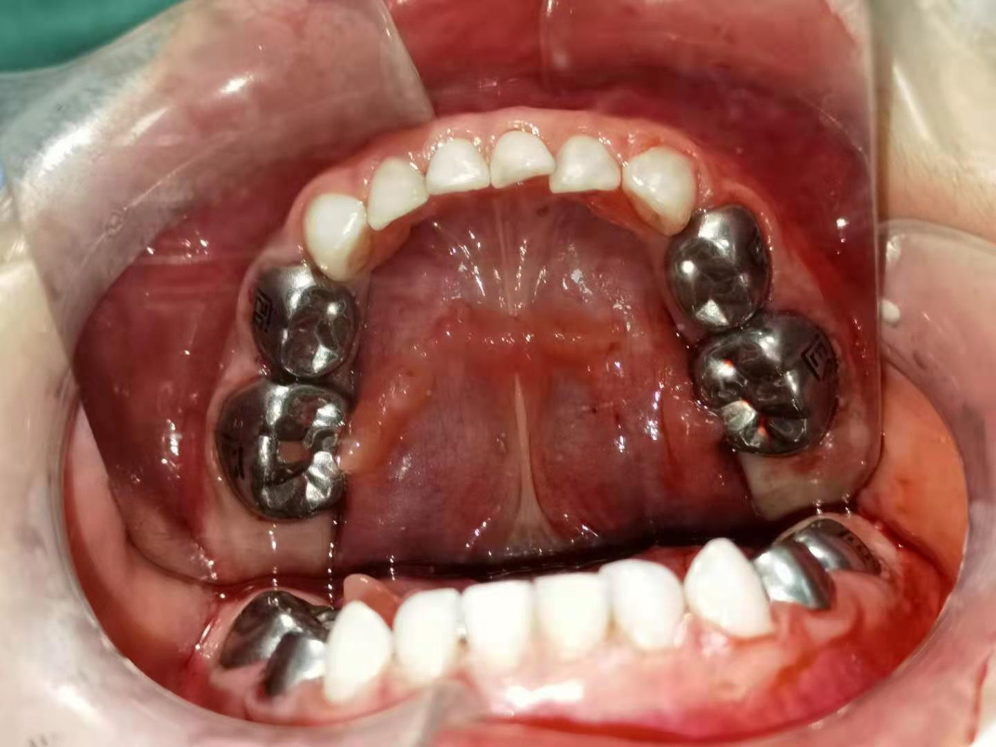 乳牙门牙预成冠图片