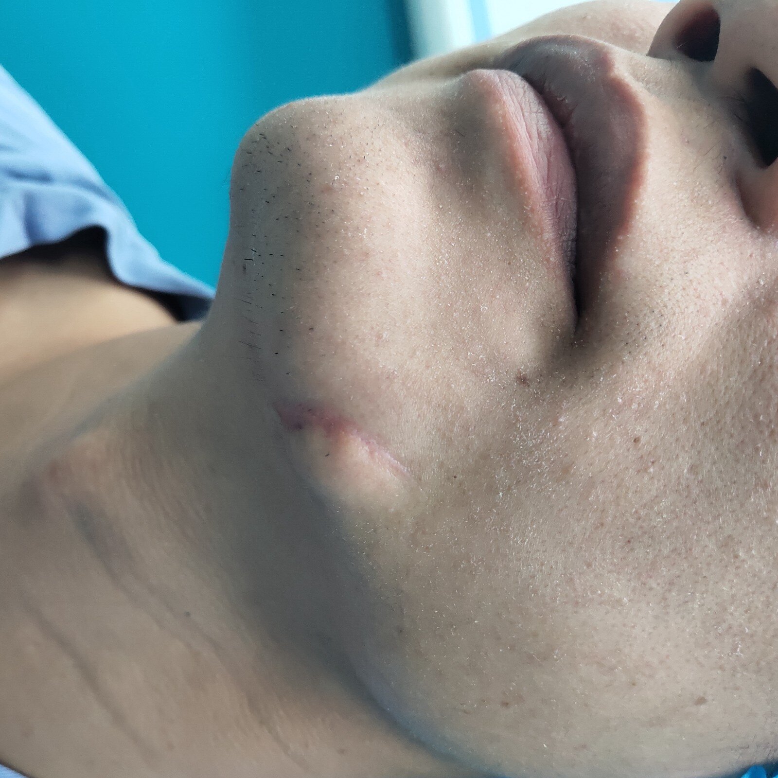 疤痕案例十四:下巴刀伤缝合后疤痕增生案例解析 