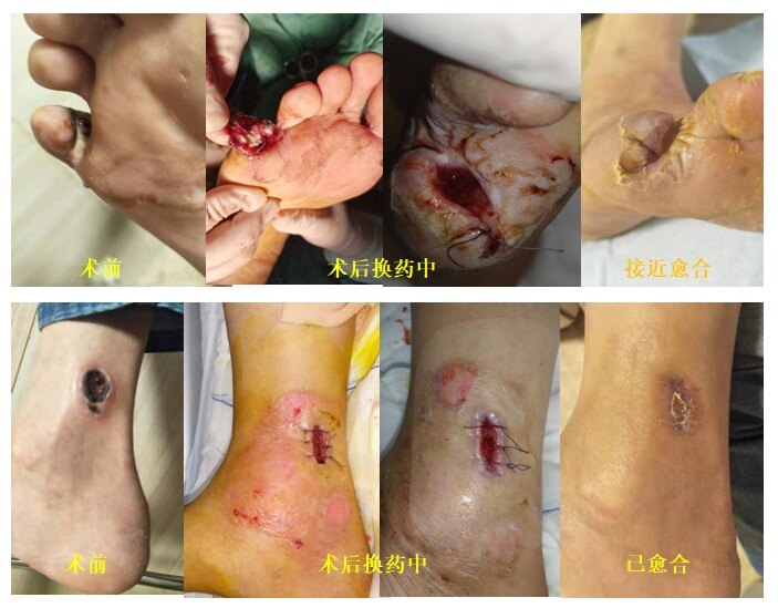 可能很快又堵了,我太难了……好在还有开放手段,自体静脉搭桥重建