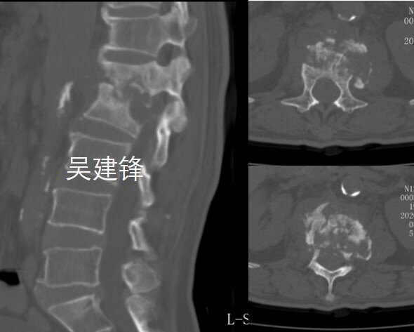 一例严重的脊柱结核伴后凸畸形的手术治疗
