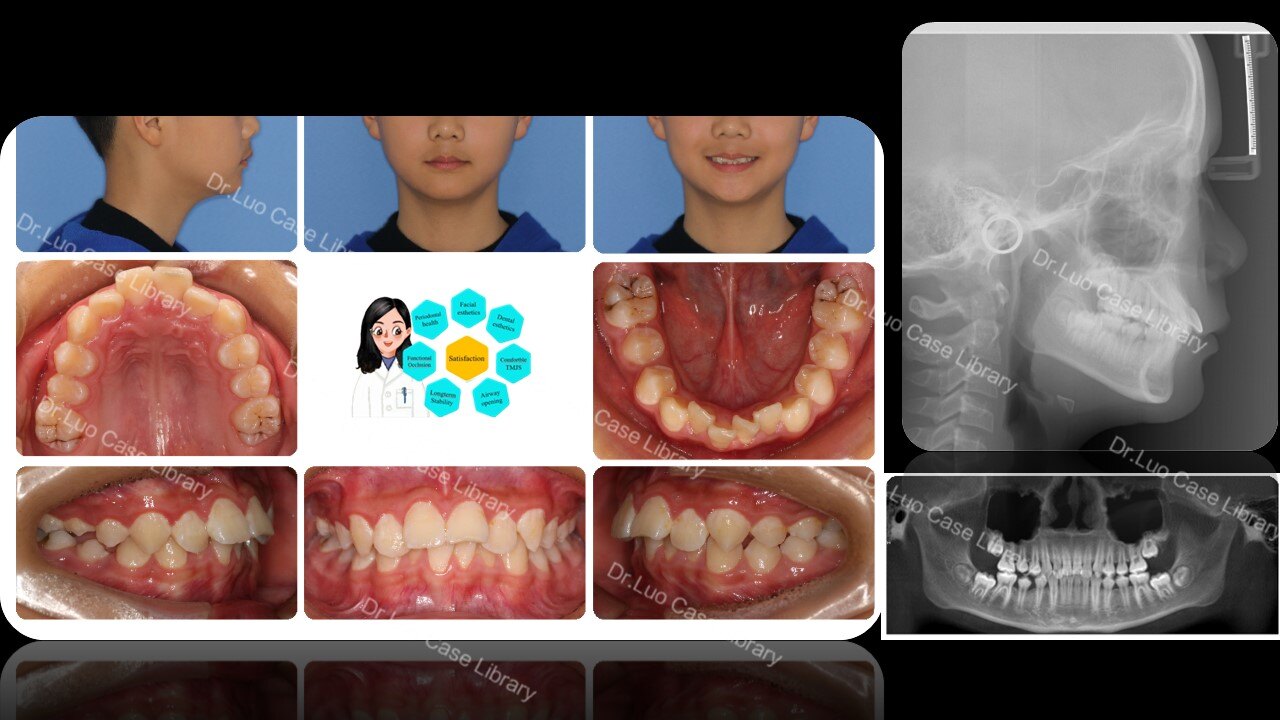 龅牙矫正##口外弓推磨牙往后##非拔牙矫正##青少年矫正#_牙颌畸形