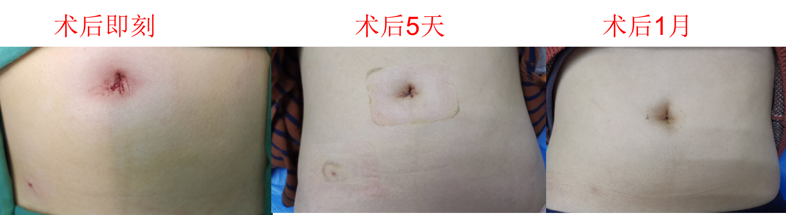 阑尾炎术后图片女性图片