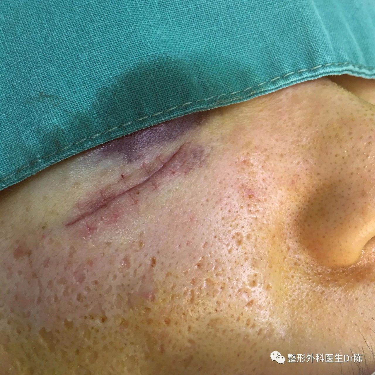 尽量减少疤痕的产生;最后我们在表面做无张力的间断缝合,使表皮完全对