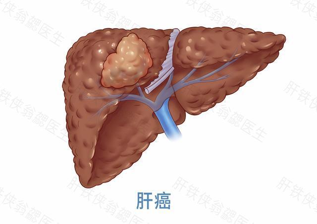 肝癌_介紹_發病原因_症狀表現_如何預防_檢查_治療方式 - 好大夫韻哌