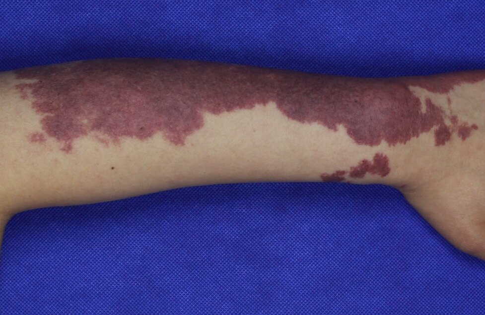 红胎记不是福报,是病,得治疗._鲜红斑痣_介绍_症状表现 - 好大夫在线