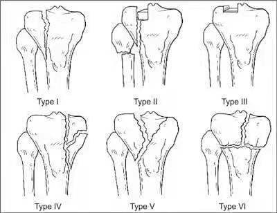 胫骨平台<!--HAODF:8:guzhe--><!--HAODF:8:guzhe--><!--HAODF:8:guzhe--><!--HAODF:8:guzhe--><!--HAODF:8:guzhe--><!--HAODF:8:guzhe--><!--HAODF:8:guzhe--><!--HAODF:8:guzhe-->骨折<!--HAODF:/8:guzhe--><!--HAODF:/8:guzhe--><!--HAODF:/8:guzhe--><!--HAODF:/8:guzhe--><!--HAODF:/8:guzhe--><!--HAODF:/8:guzhe--><!--HAODF:/8:guzhe--><!--HAODF:/8:guzhe-->Schatzker分型.jpg