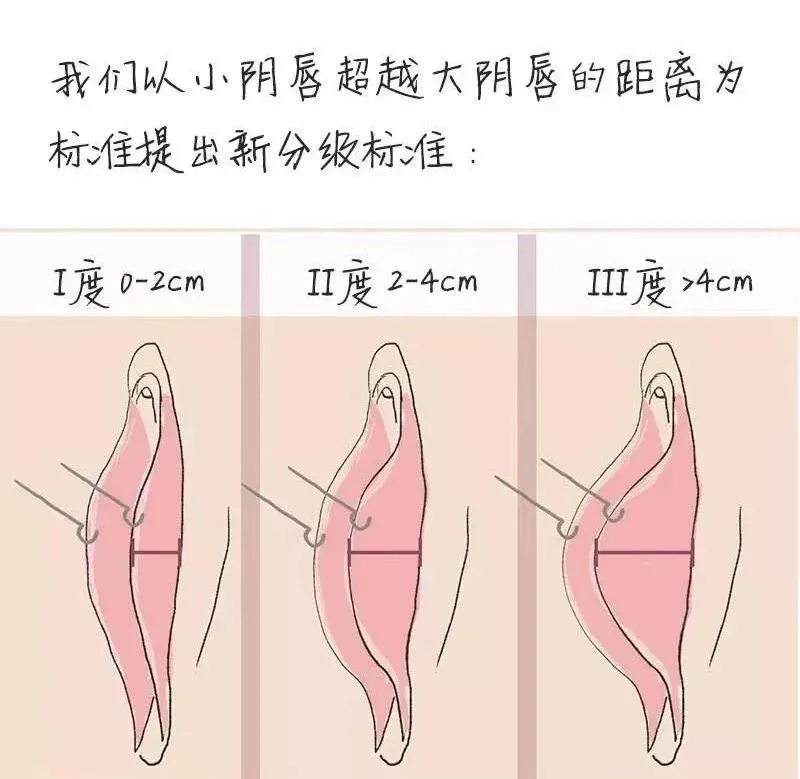 【私密整形】:小阴唇健康自测