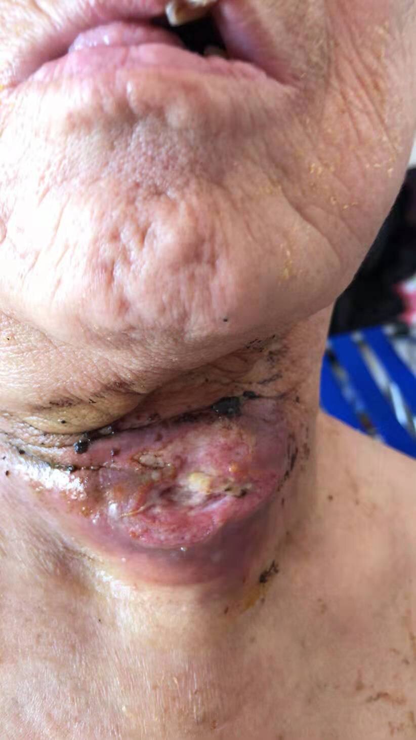 囗腔癌晚期症状图片_乳腺晚期癌能活多久_乳腺癌晚期症状图片