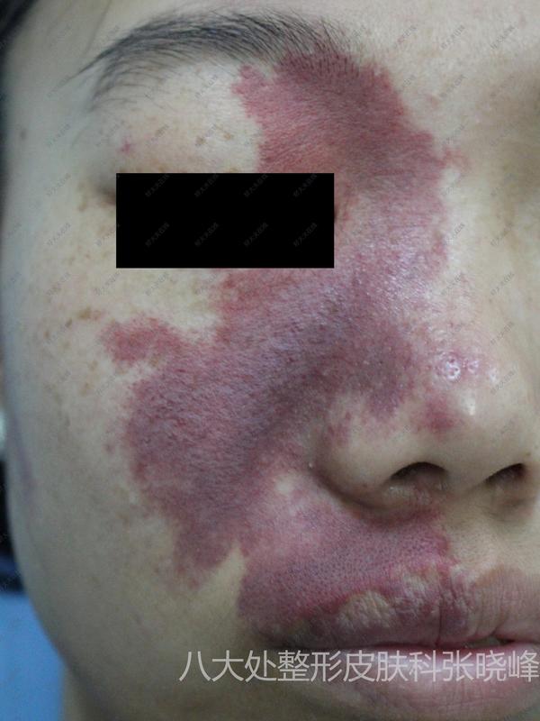 红胎记_鲜红斑痣 - 好大夫在线