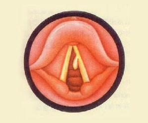 声带息肉,乳头状瘤,声带黏膜下囊肿,黏膜下血肿,接触性溃疡及肉芽肿