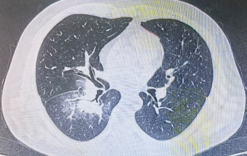 病史 ct表现,基本认定是吸入性肺炎.