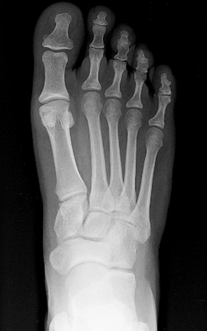 足部骨折x光片图片