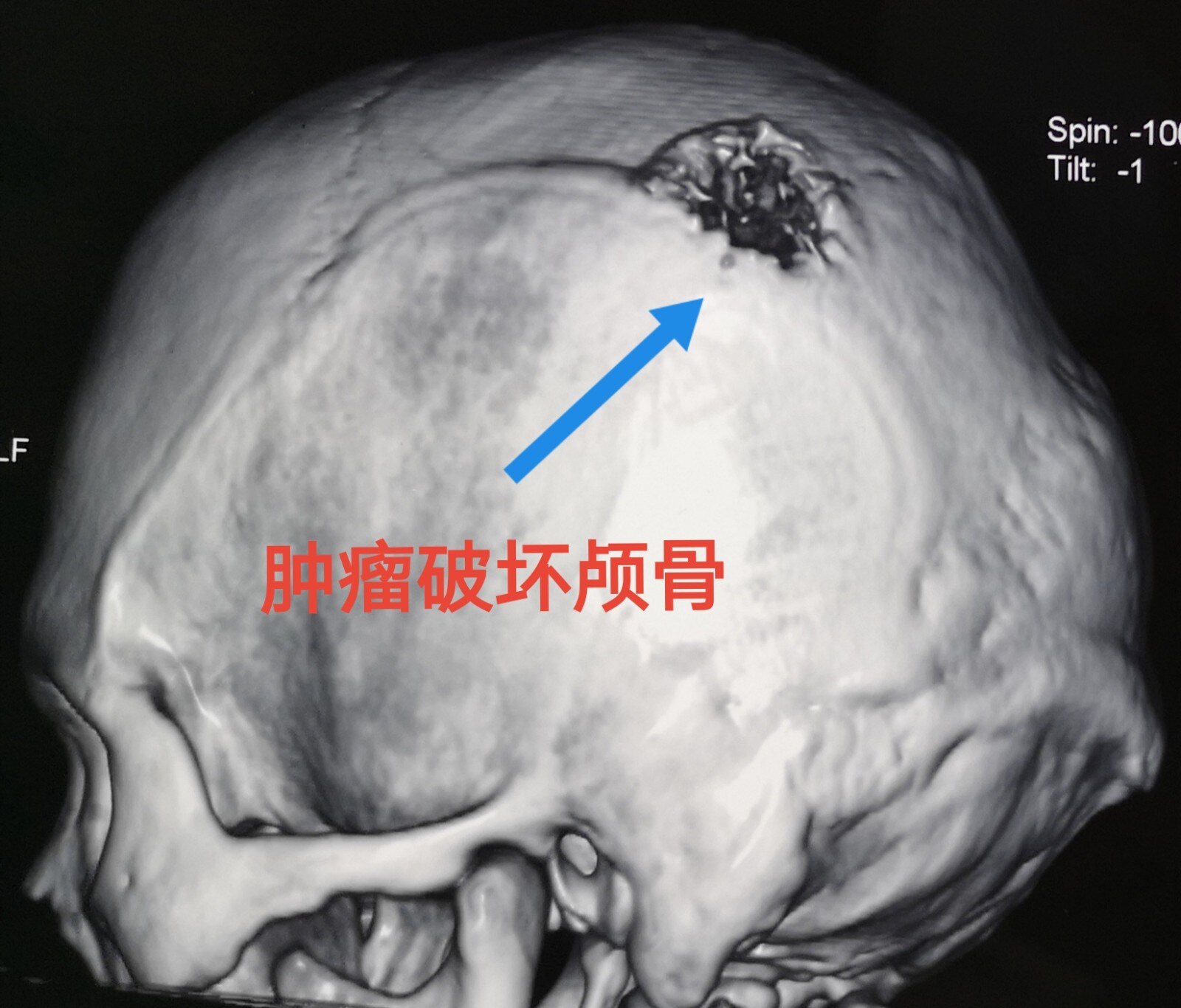肿瘤对颅骨有破坏,查了头部ct,果然,肿瘤穿破颅骨向颅内生长看见这么