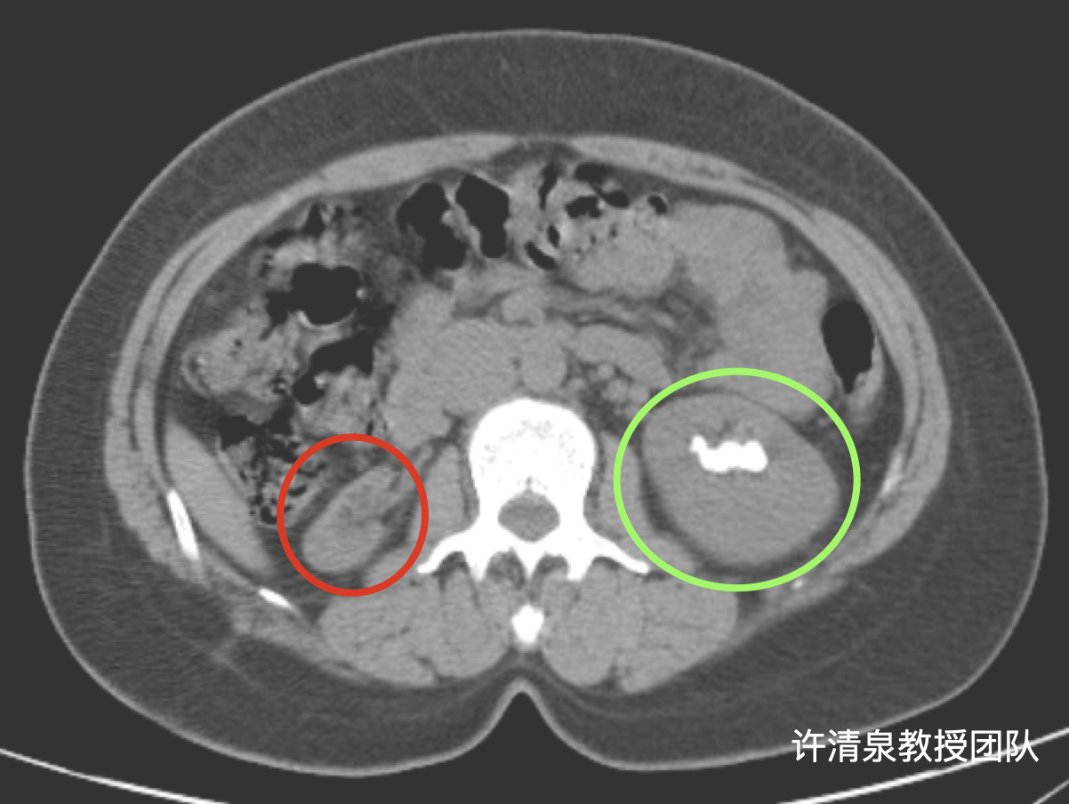 左肾结石