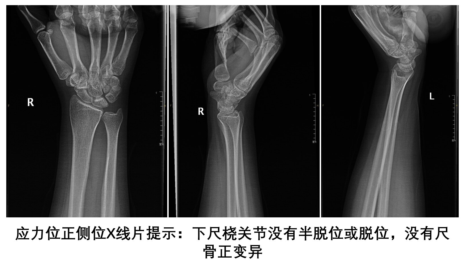 腕背屈角度图片