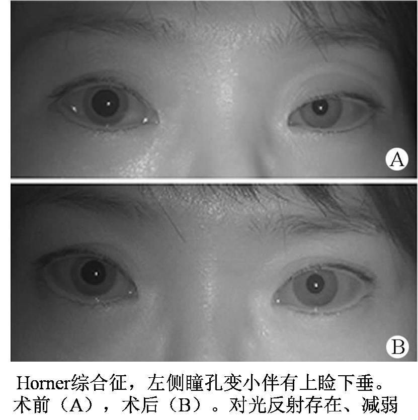 上睑下垂的诊断治疗和护理