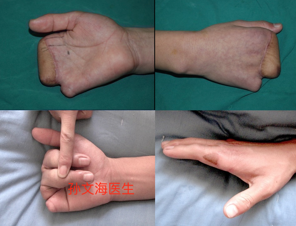 拇手指再造附案例集