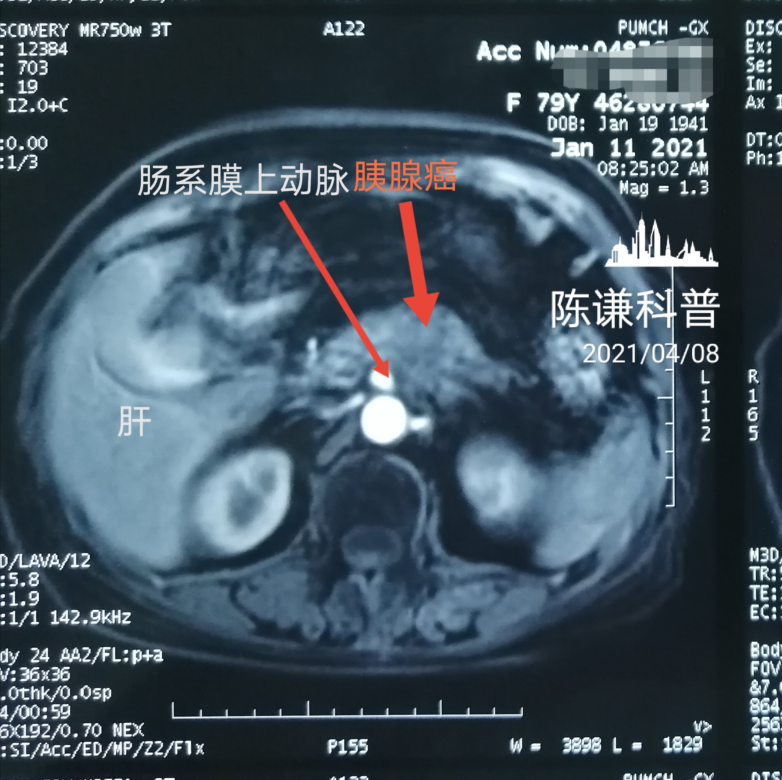 胰头癌声像图表现图片
