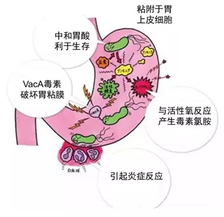 這種可能致癌的細菌,一半的國人都被感染了_胃幽門螺桿菌感染 - 好