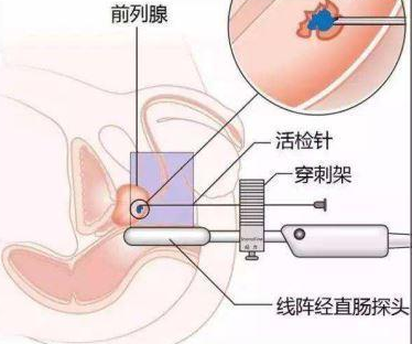 前列腺穿刺部位示意图图片