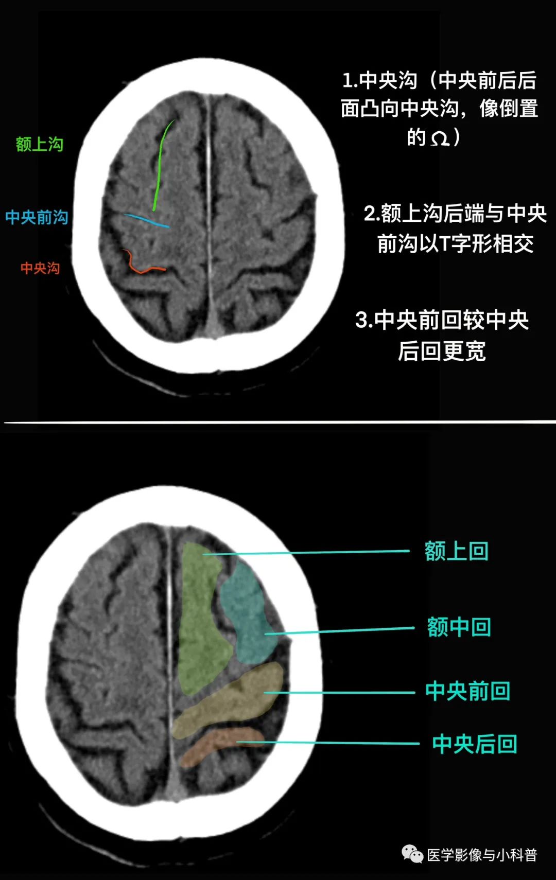 1. 第一步:先找中央沟,中央沟前为额叶,后为顶叶