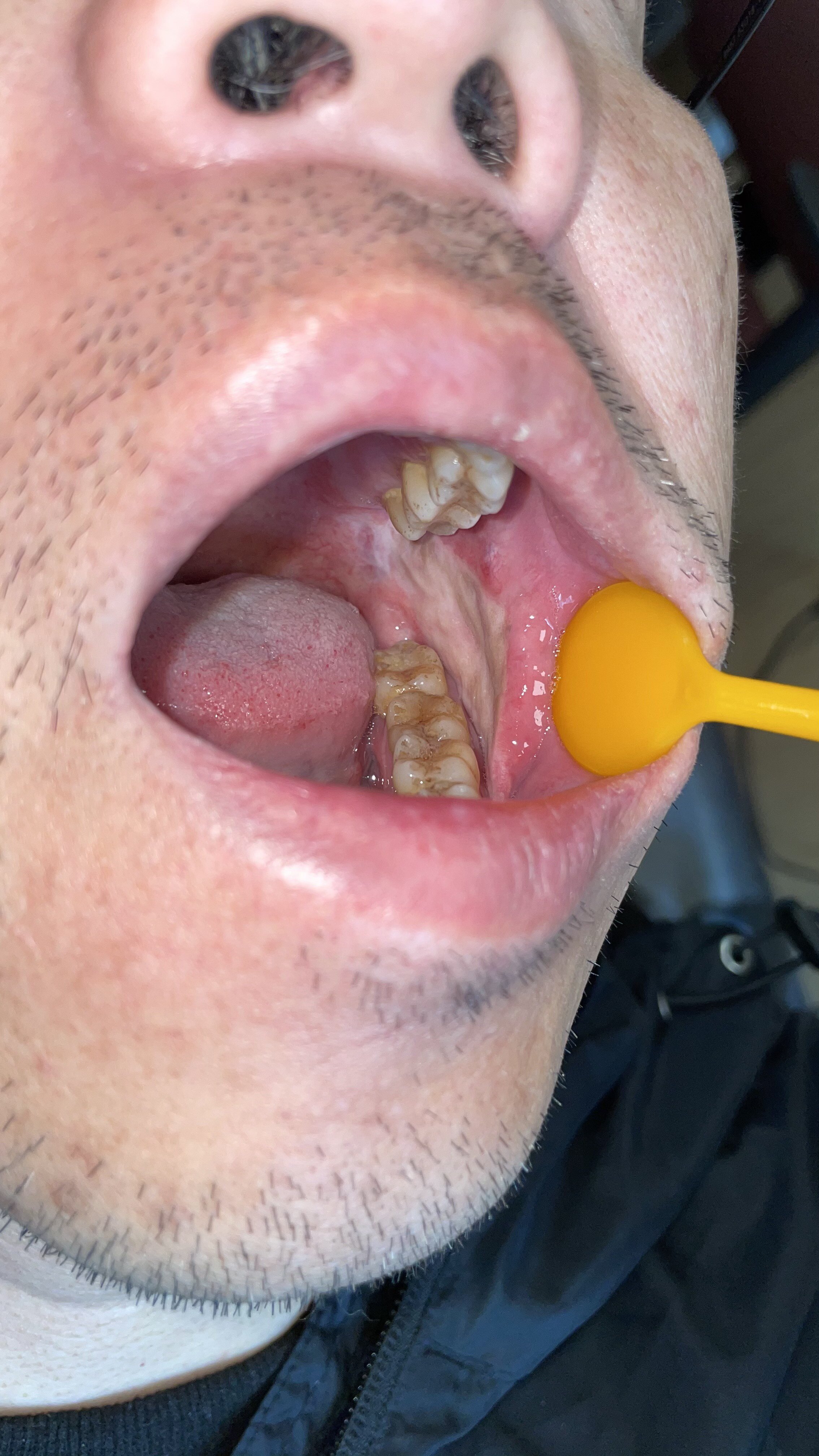 口腔肿瘤防治,需早治!