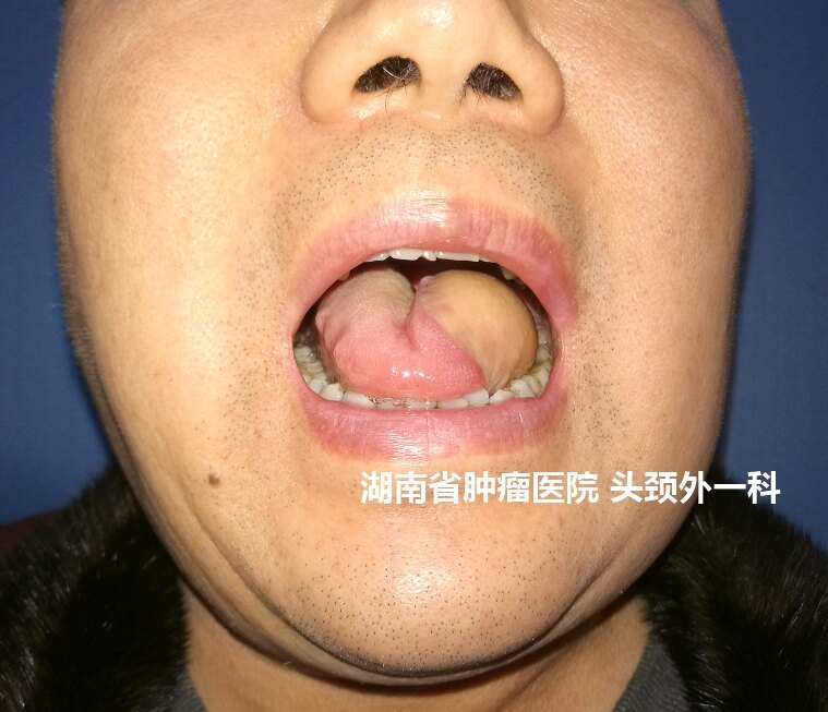 舌头鳞状细胞癌图片图片