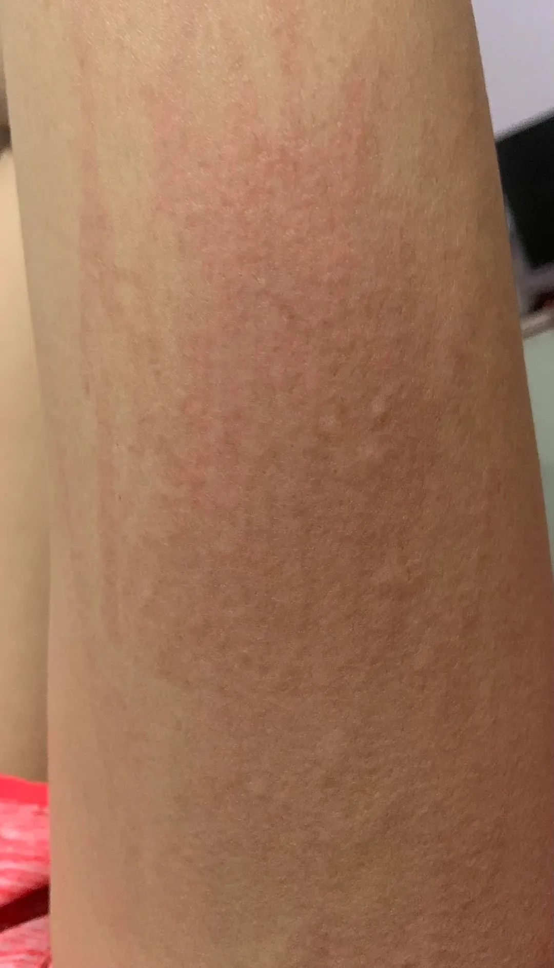 这种荨麻疹的高发季来了,不传染但有点小变态