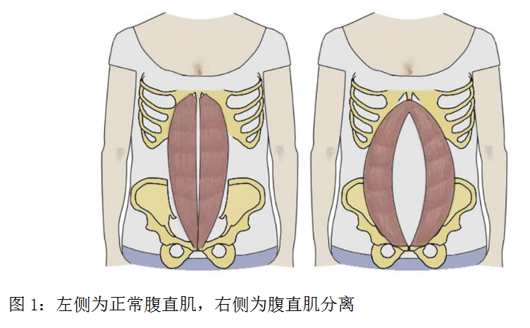 腹直肌鞘位置图图片