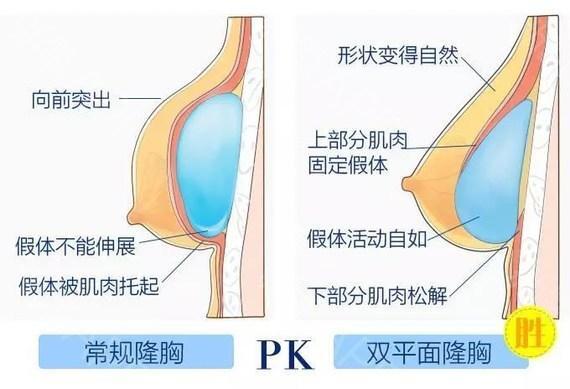 什麼是內窺鏡隆胸手術?有哪些特點呢?