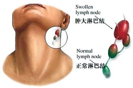 淋巴扁桃体位置图片图片