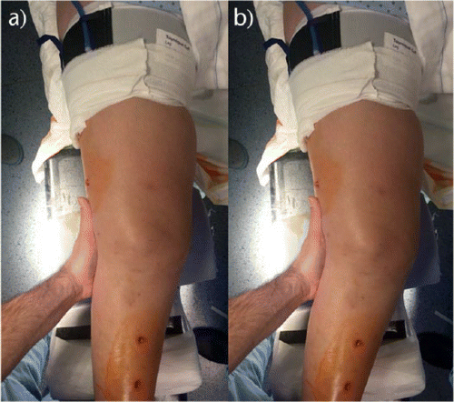 膝关节韧带损伤_膝关节韧带损伤治疗方式 - 好大夫在线
