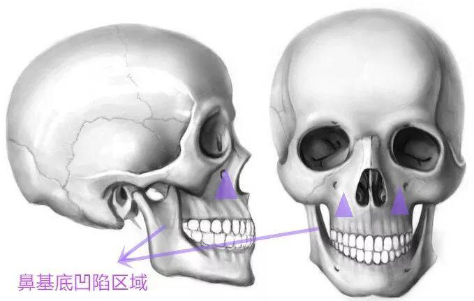 鼻子中间软骨凹下去图片