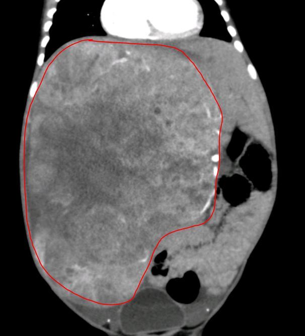 手术联合化疗治疗巨大肝母细胞瘤_肝母细胞瘤_肝母细胞瘤治疗方式