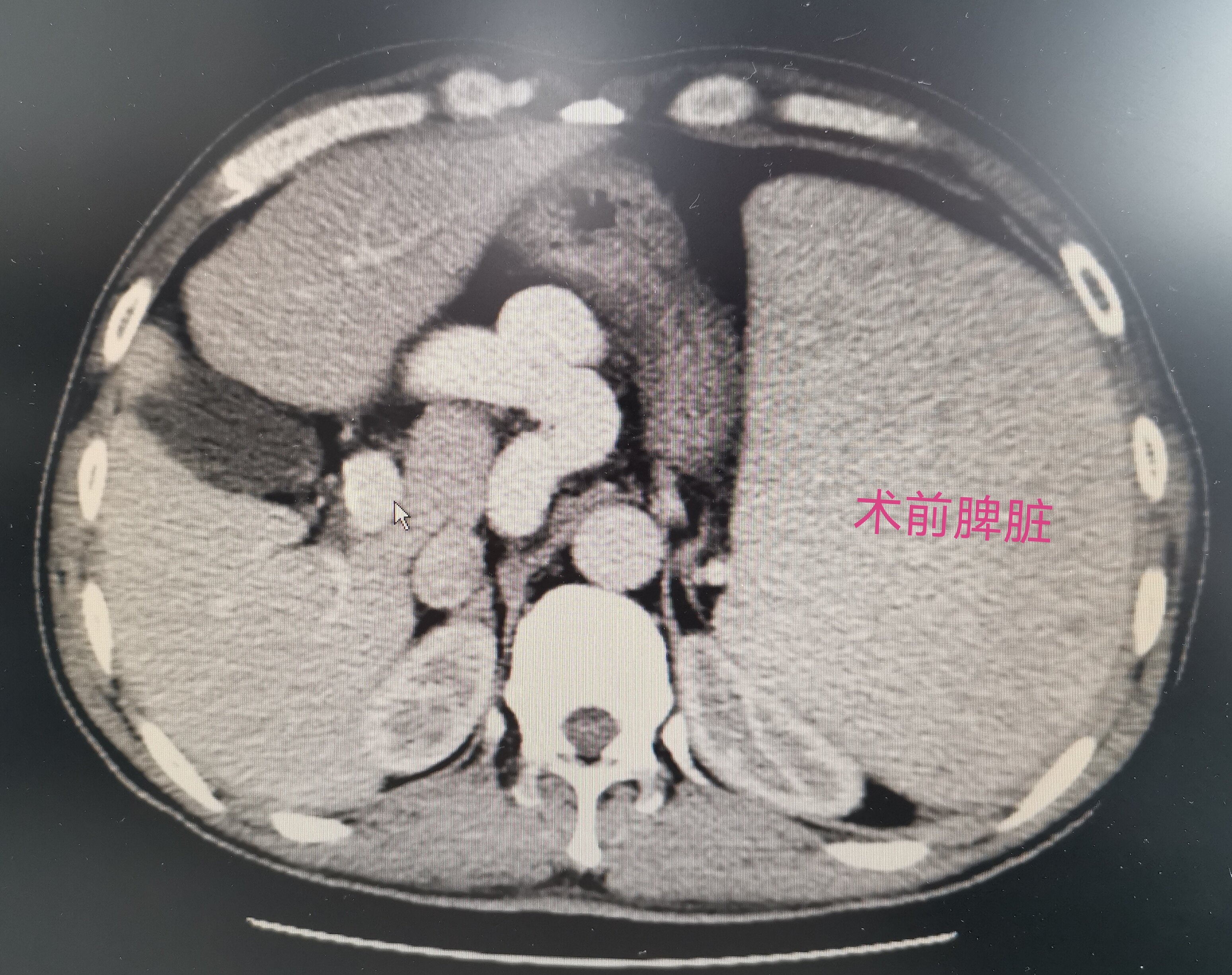 門脈高壓合併食道胃底靜脈曲張,巨脾,脾亢患者行脾部分切除斷流術的