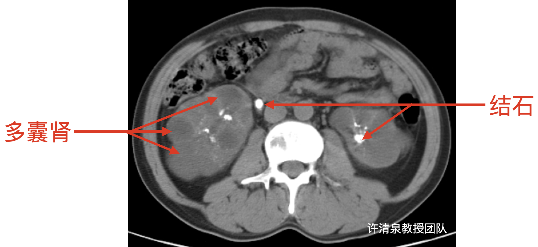 肾结石多囊肾