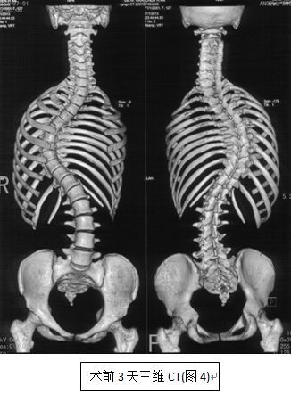诊疗方案:在全麻下行脊柱畸形后路矫形,钉棒系统内固定,植骨融合术.