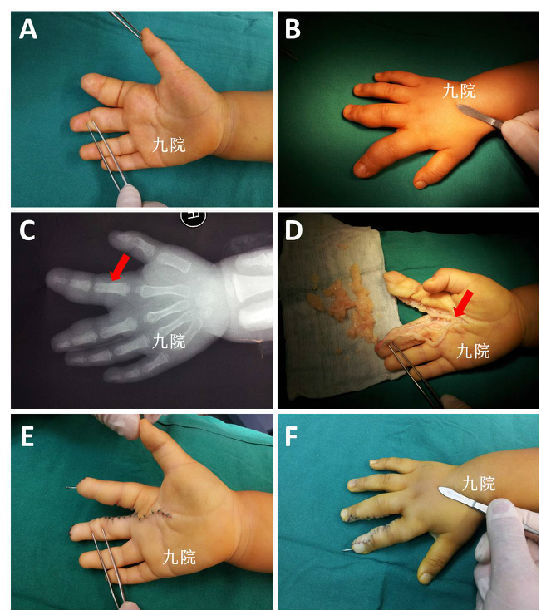 巨指(趾)症简介和临床治疗_先天性足畸形_疾病介绍_介绍 - 好大夫在线