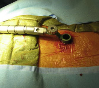 腰椎手术钢钉图片图片
