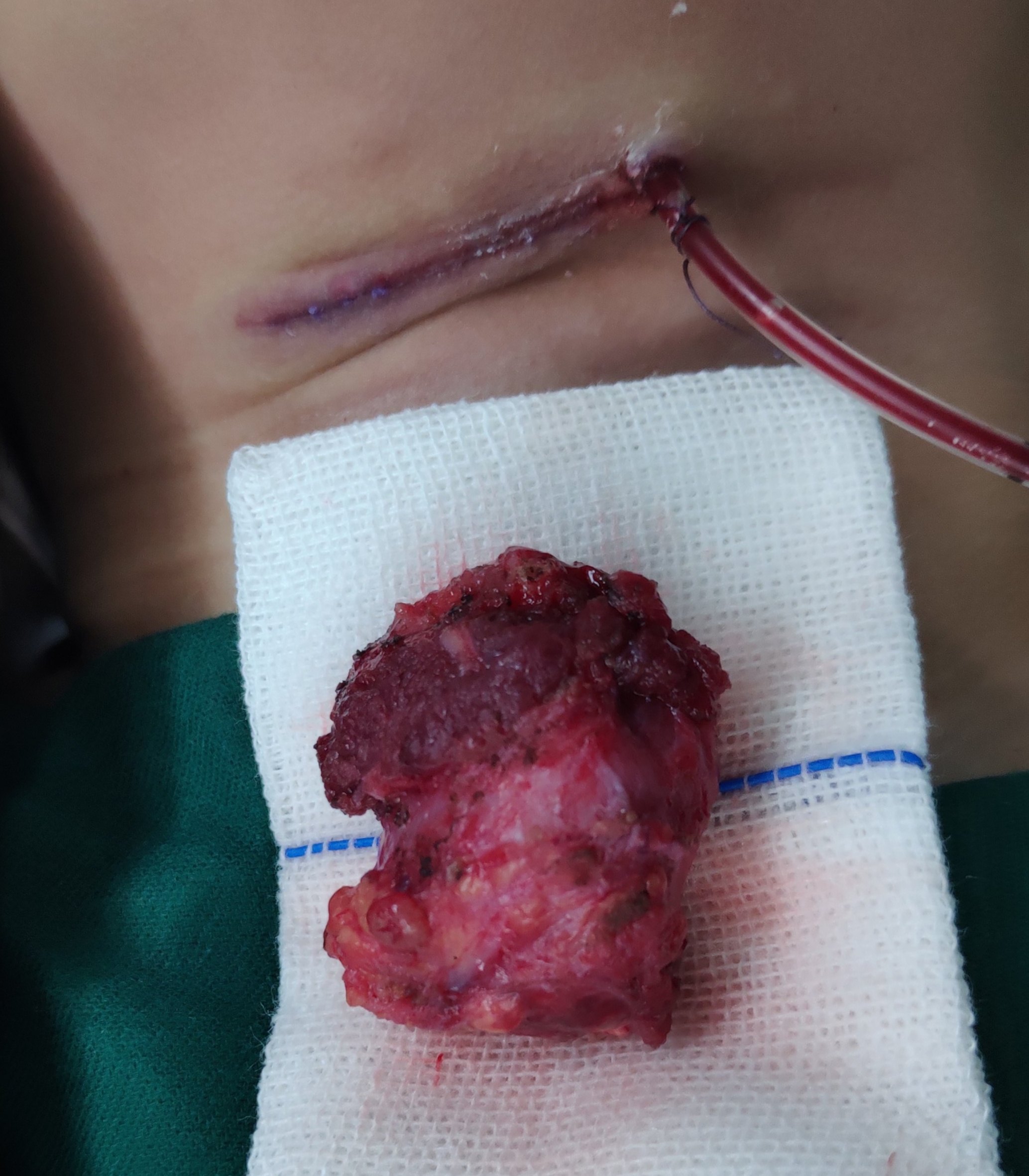 秦昊秦昊医生手记～20190515感染甲舌囊肿切除 - 好大夫在线