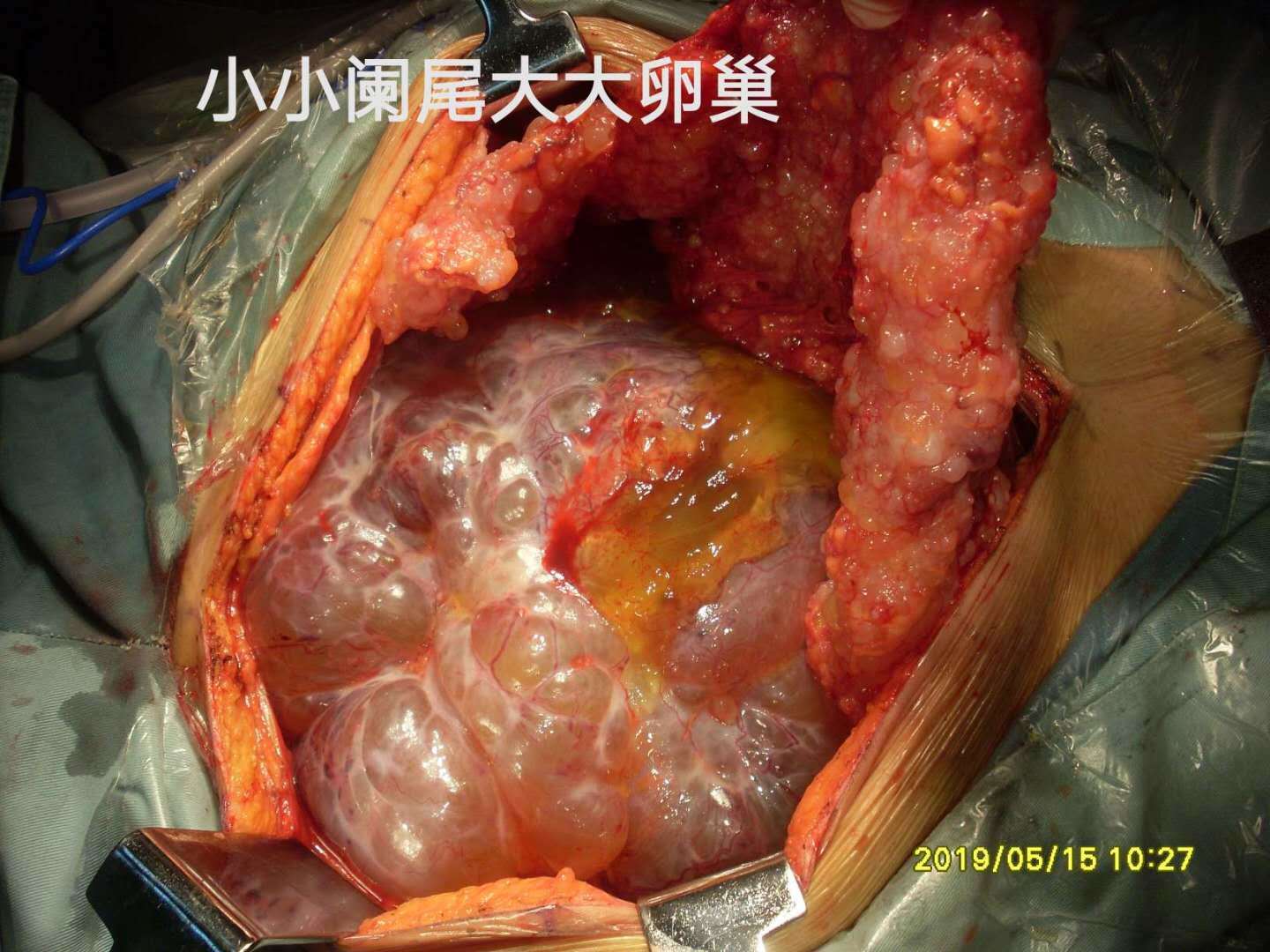 病例63闌尾pmp巨大卵巢粘液囊腫擠佔腹腔致高腹壓