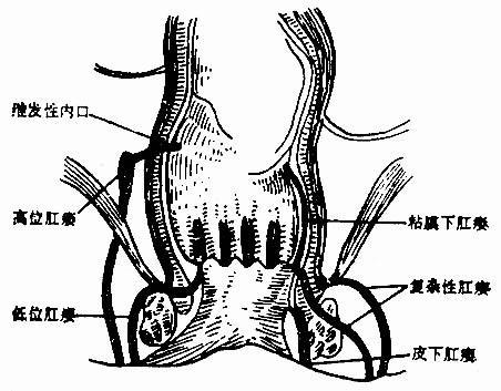 括约肌间肛瘘图片