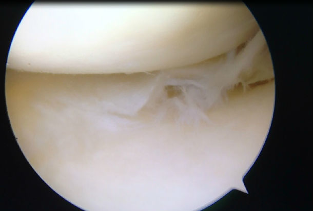 鏡下全內縫合技術治療膝關節內側半月板后角損傷_關節鏡_關節鏡手術