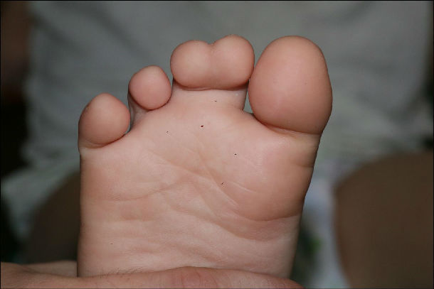 我们创建了系列新术式治疗小儿先天脚趾畸形,改变了国内外原来都需要