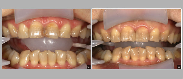 四环素牙的门牙树脂充填修复一例
