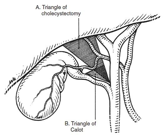 图1 胆囊三角区示意图图2 胆囊动脉的变异图3 胆囊管走行变异图4 胆囊