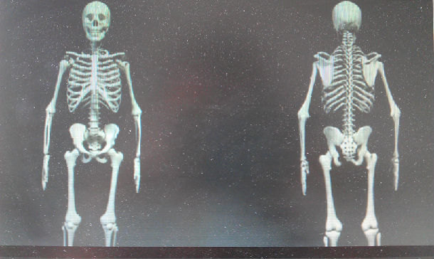 3d骨骼图演示脊柱侧弯在青少年不同年龄段的变化
