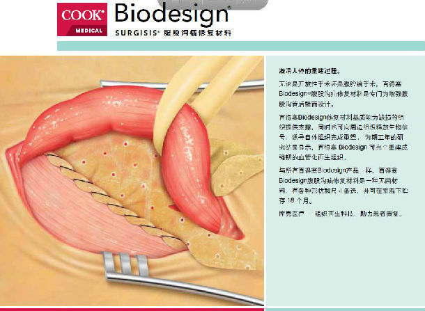 疝补片修补术图片